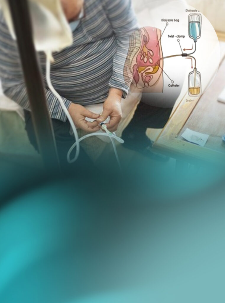 CAPD (Continuous Ambulatory Peritoneal Dialysis)